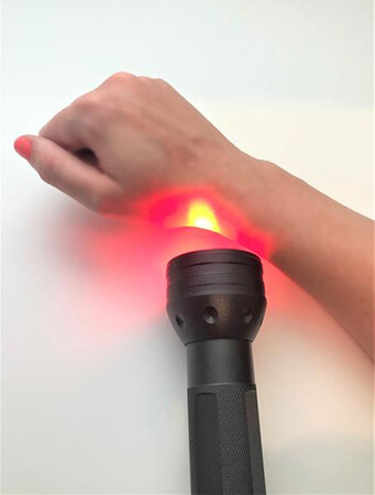 Hand with light therapy device