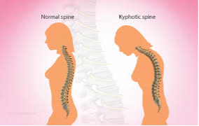 Kyphotic-illustration-female-sideview