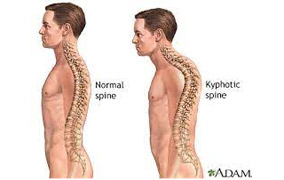 Kyphotic-spine-illustration-side-view