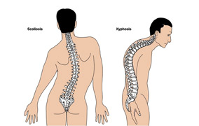 kyphosis-illustration-back-and-side-view