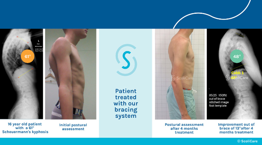 kyphosis scoli brace on male patient