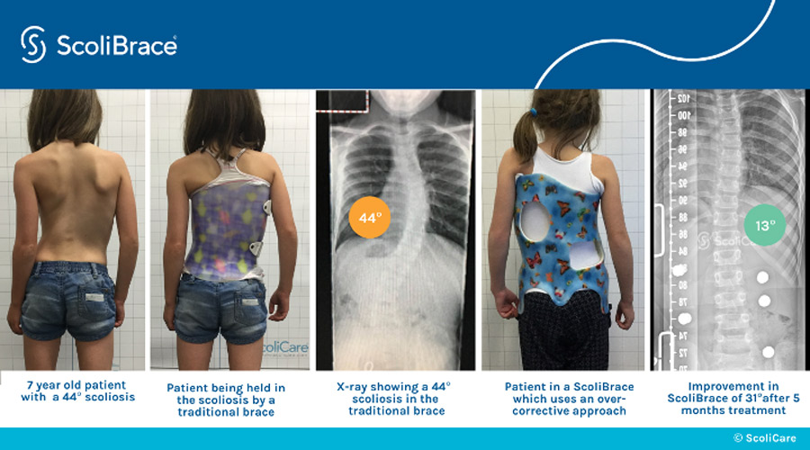 scoli brace on 7 year old patient