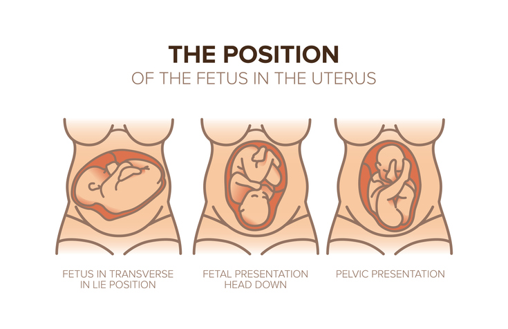 Position of the Fetus