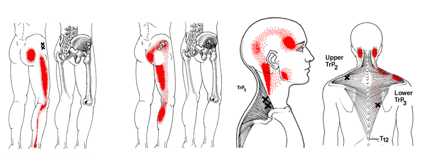 Myofascial pain and Dysfunction