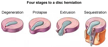 discherniation