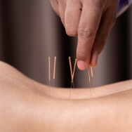 acupuncture