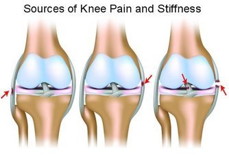 knee-pain-causes