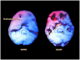 Here we see the actual brain (using PET scan) of a normal person compared to a person who has violent tendencies.