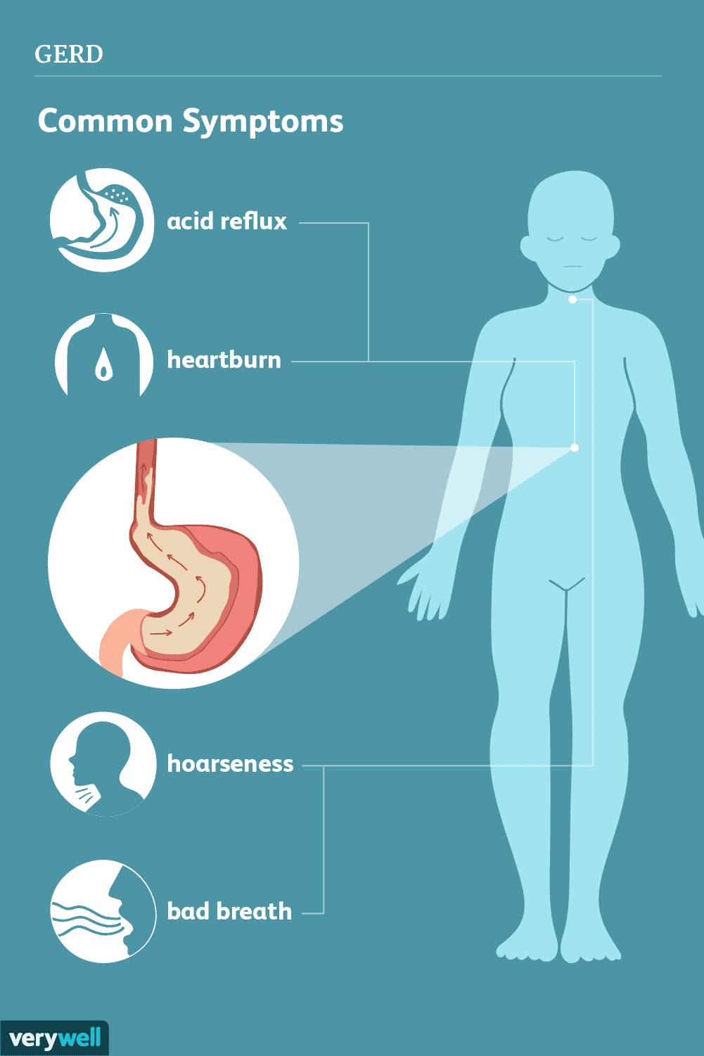 GERD_symptoms-5ae77590119fa80036eb2edf