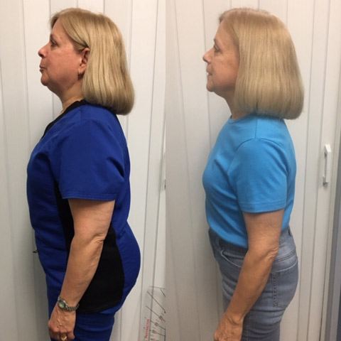 Side view of Diane before and after