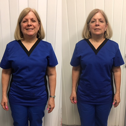 Diane H. Before and After Images