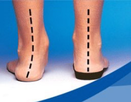 Custom Orthotics