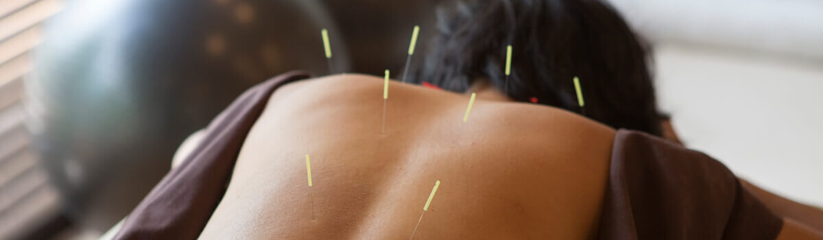 acupuncture needles in persons back