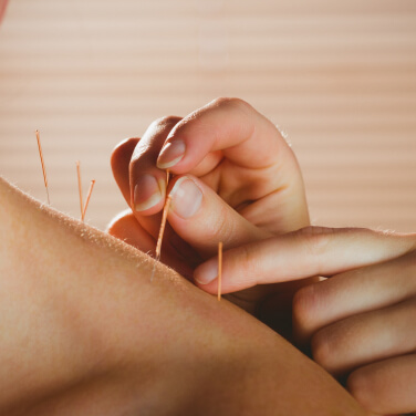 acupuncture