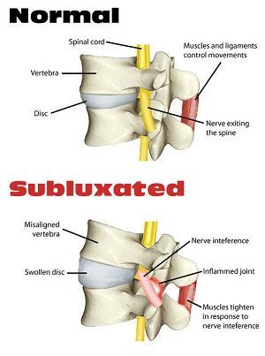 vertebral-subluxation-pic