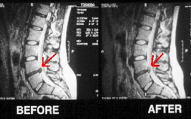 mri image of a spine