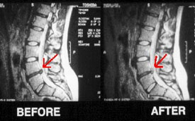 Strap Spinal Decompression  Y-Strap Spinal Decompression