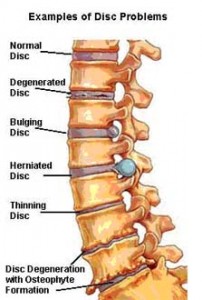 image of spinal disc