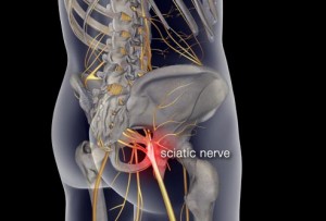 Sciatica Med Image