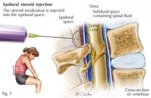 epidural1