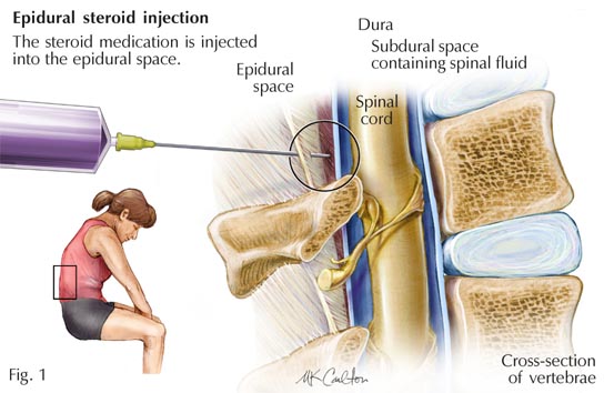 Steroid Injections for Back Pain