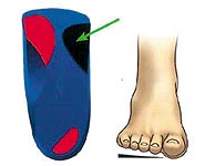 Flat feet with orthotic insert