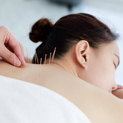 acupuncture-needles-in-relaxed-womans-upper-back-sq