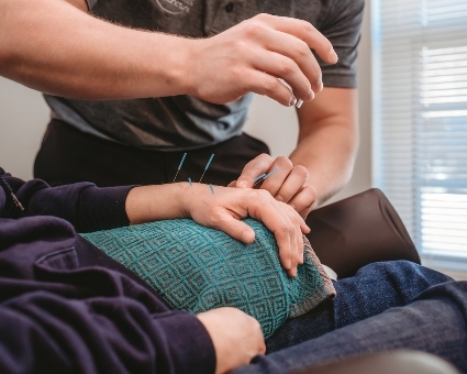 Patient's hand treated with acupuncture
