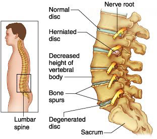 Disc Pain Treatment Chiropractor Torrance Back To Healthcare Chiropractic