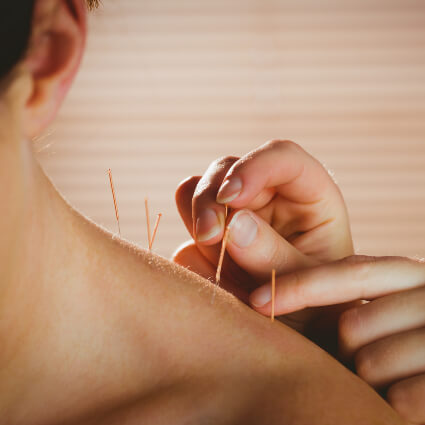 Patient shoulder treated with acupuncture