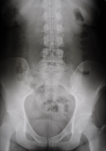 scoliosis after