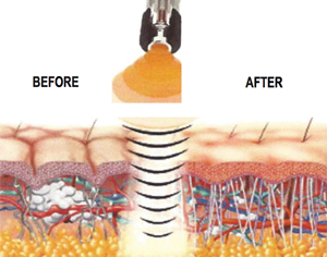 acoustic-wave-therapy-2