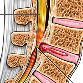 Spinal Stenosis illustration