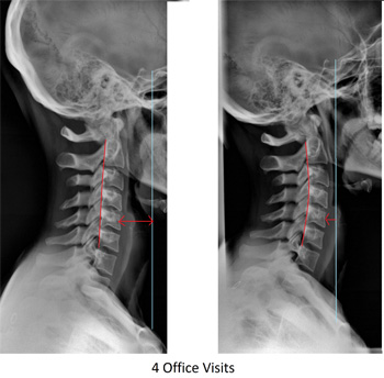 spine xrays