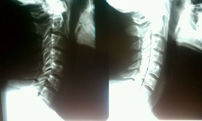 before and after neck scans