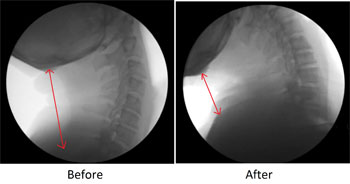 before and after xrays