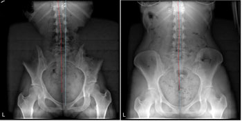 lower spine xrays