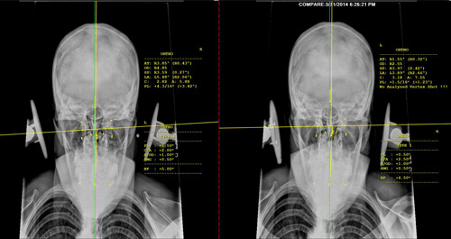 Auto Accident Recovery xrays