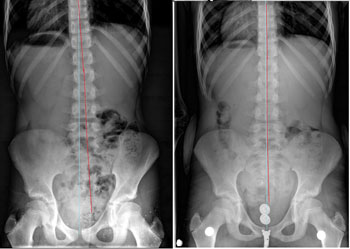 spine and hip xray