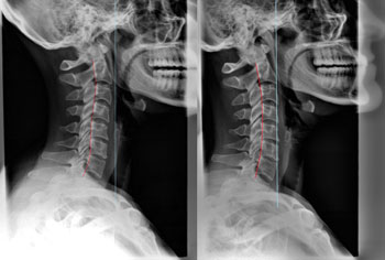 neck xray comparisons