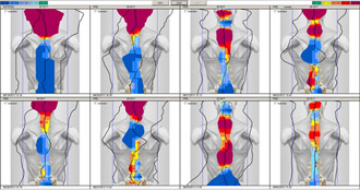 Spinal Thermography scan