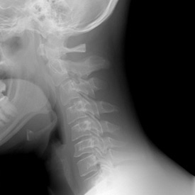 x-ray of a spine