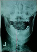 Vertebral Subluxation Vertebral Subluxation