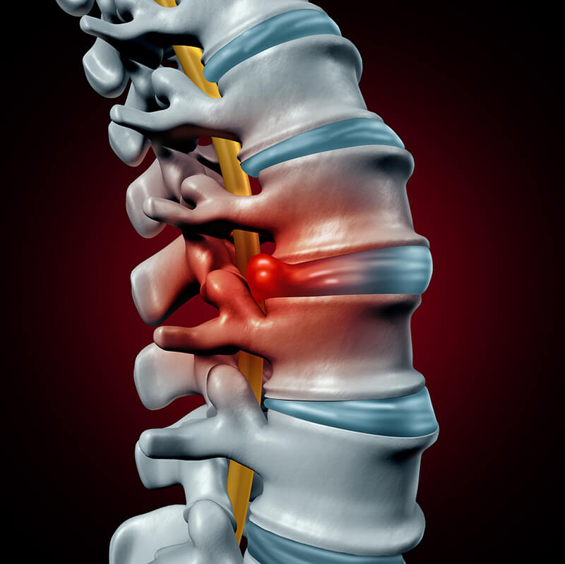 herniated-disc-1