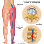 Sciatic diagram