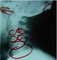 On your second visit, Dr. VanDehey will review the results of your X-rays and answer any questions. cervical xray