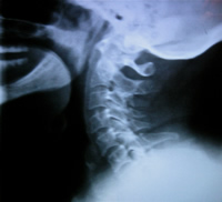 Patient A After Embrun Chiropractic xray