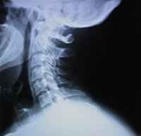 Patient A Before Embrun Chiropractic xray
