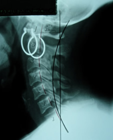 Patient B Before Embrun Chiropractic x-ray