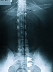 Patient C After Embrun Chiropractic x-ray